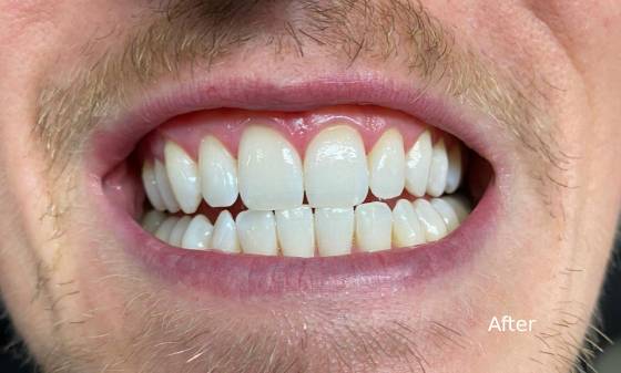 Teeth whitening that works on fillings